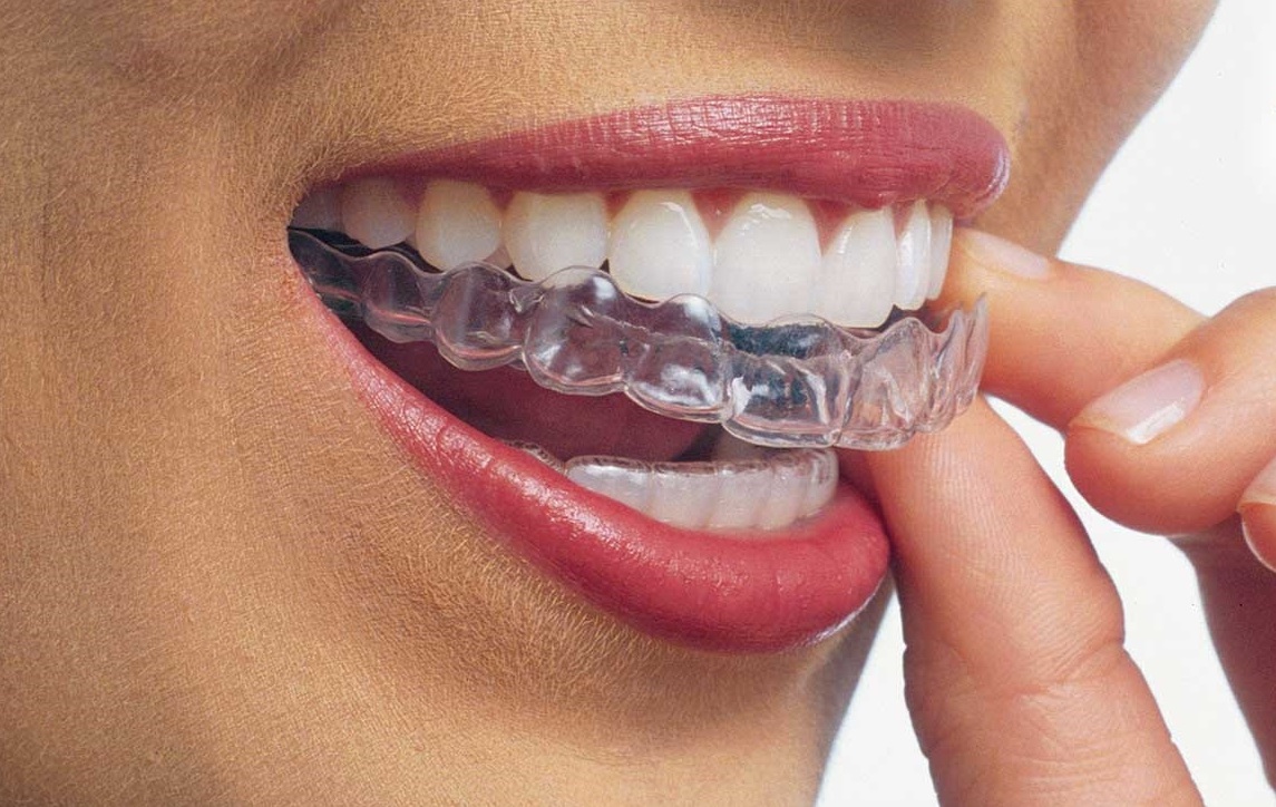 Invisalign clear aligners being placed on teeth